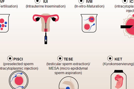 Künstliche Befruchtung: Interaktive Grafik zeigt die unterschiedlichen Methoden der künstlichen Befruchtung.