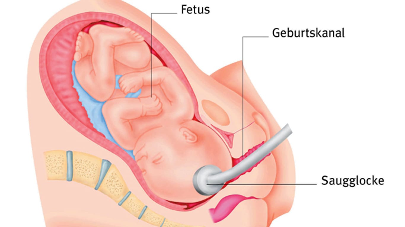 Bei manchen Geburten wird der Einsatz einer Saugglocke oder Zange nötig - etwa, wenn die Entbindung ins Stocken geraten ist.