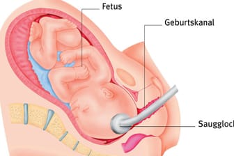 Bei manchen Geburten wird der Einsatz einer Saugglocke oder Zange nötig - etwa, wenn die Entbindung ins Stocken geraten ist.