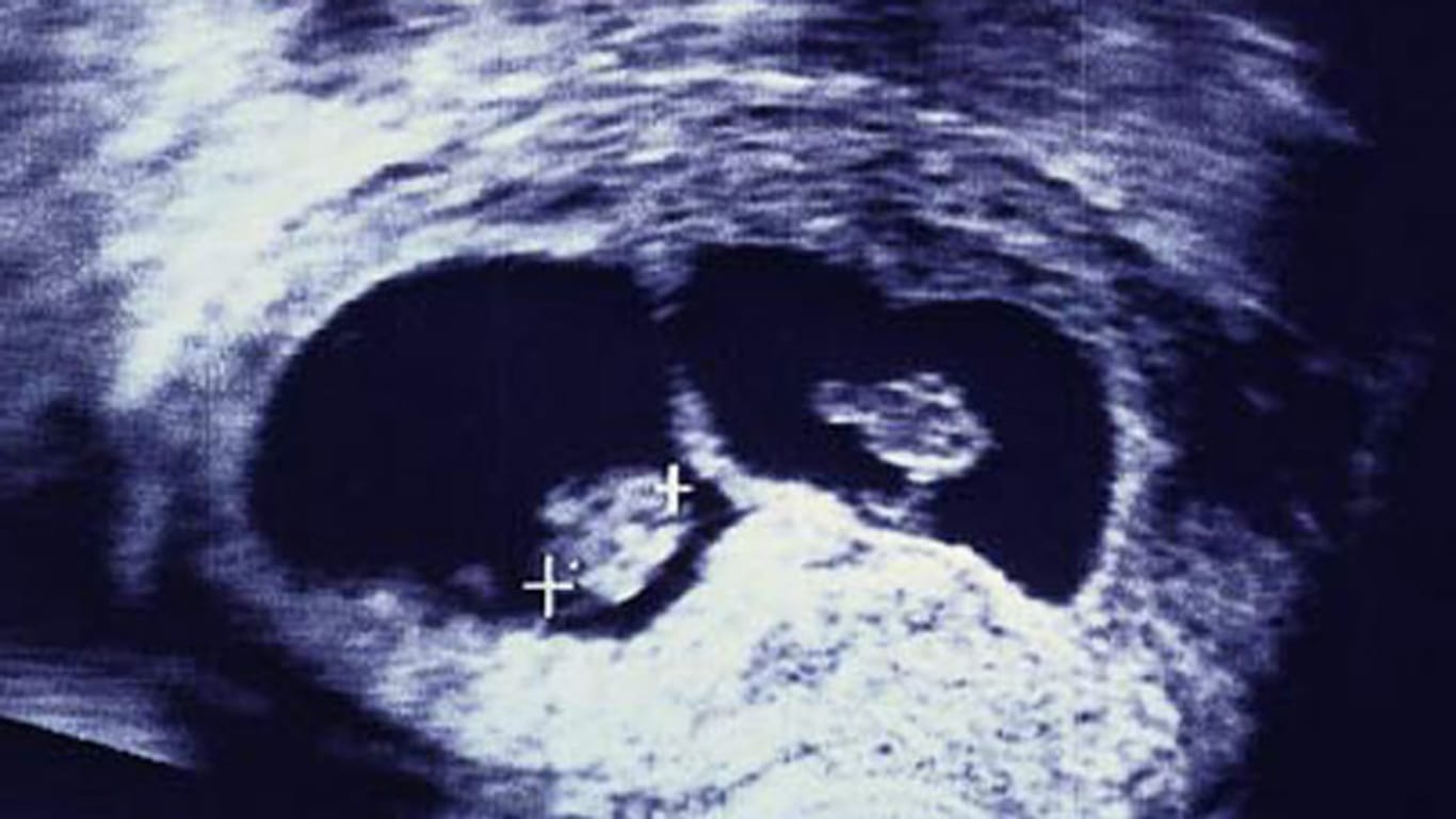Im Ultraschall können Ärzte Zwillingsschwangerschaften genau überwachen.