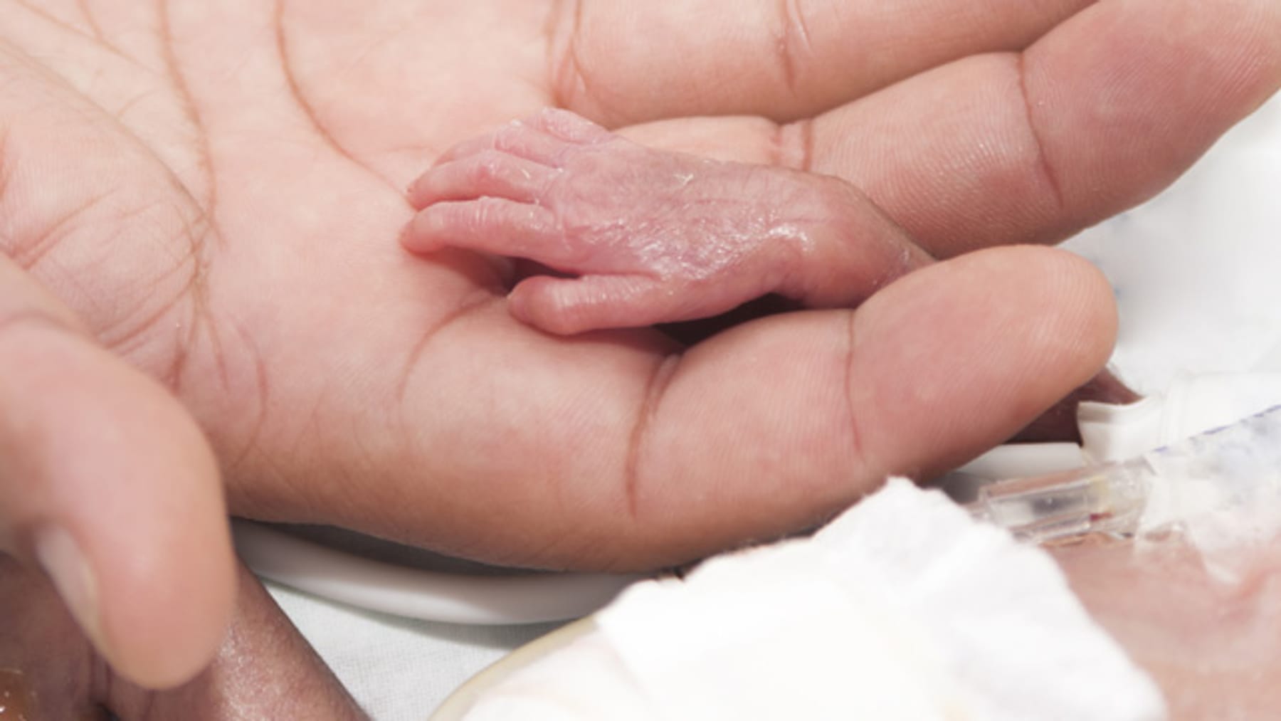 Родился вперед руками. Родился вперед руками. Недоношенный новорожденный ребенок. Родился вперед руками. Родился вперед руками.