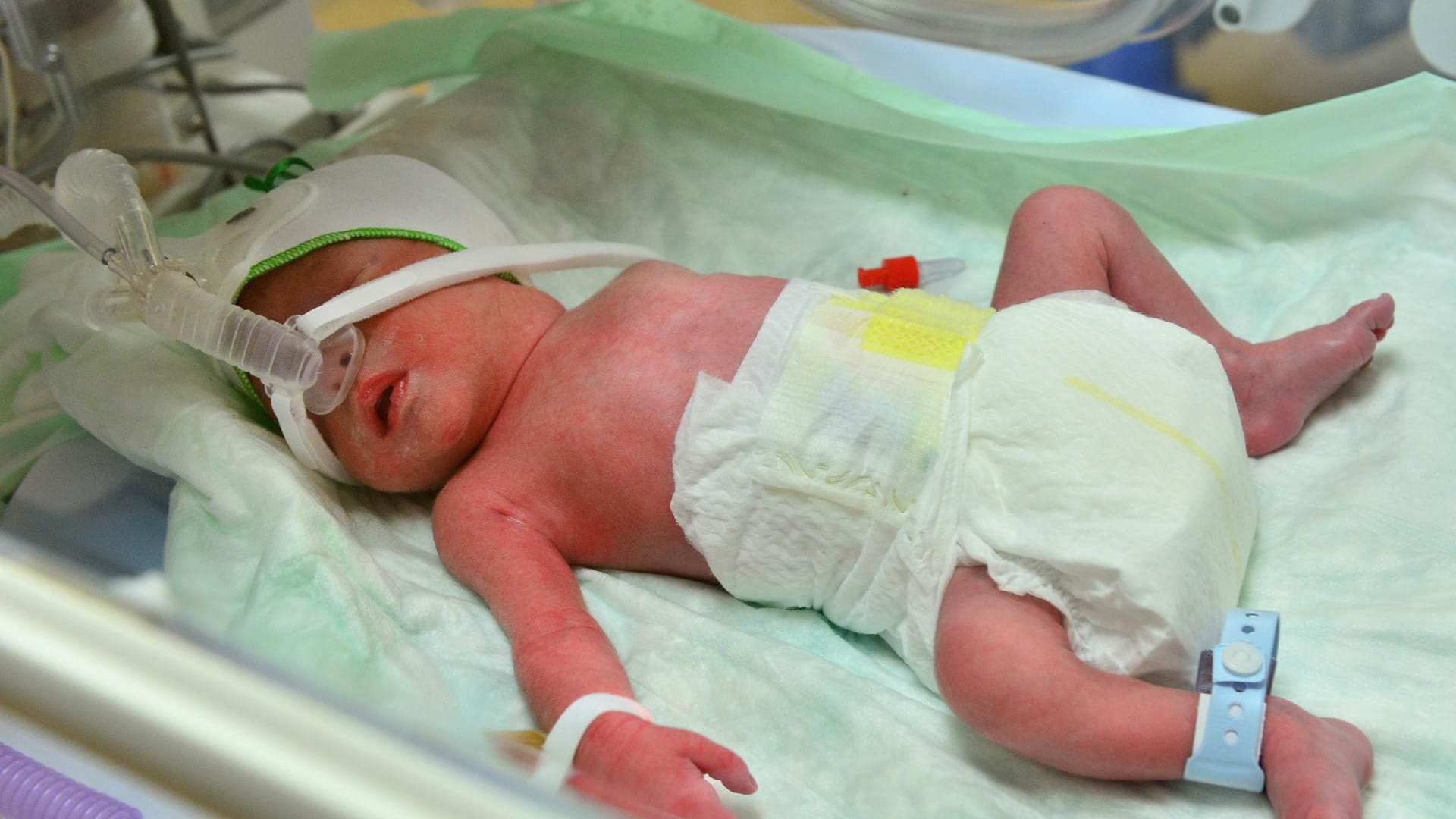 Vierlinge: Der kleine Frederic liegt im Brutkasten. Er ist einer der Vierlinge, die eine aus Albanien geflohene Frau in der Uni-Klinik Jena zur Welt gebracht hat. Vierlinge: Der kleine Frederic liegt im Brutkasten. Er ist einer der Vierlinge, die eine aus Albanien geflohene Frau in der Uni-Klinik Jena zur Welt gebracht hat.