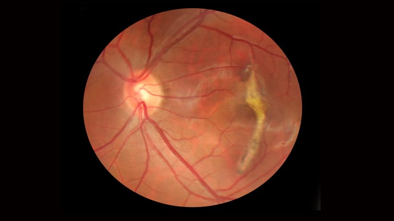 So sieht ein Augenarzt das Auge: Auf dieser Netzhautspiegelung ist rechts eine Vernarbung der Makula sichtbar.