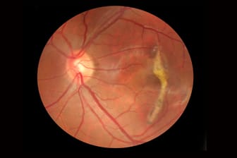 So sieht ein Augenarzt das Auge: Auf dieser Netzhautspiegelung ist rechts eine Vernarbung der Makula sichtbar.