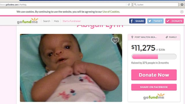 Die kleine Abigail Lynn leidet am "Treacher Collins Syndrom".