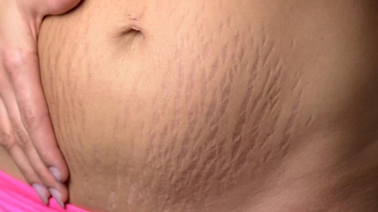 Kann man Schwangerschaftsstreifen am Bauch mit dem Laser entfernen?