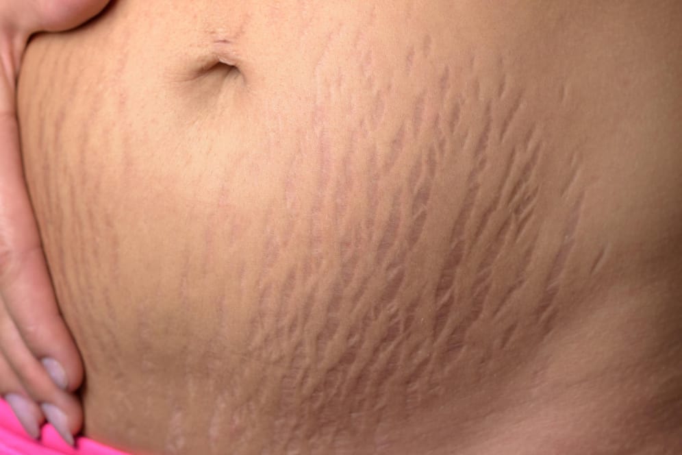 Kann man Schwangerschaftsstreifen am Bauch mit dem Laser entfernen?
