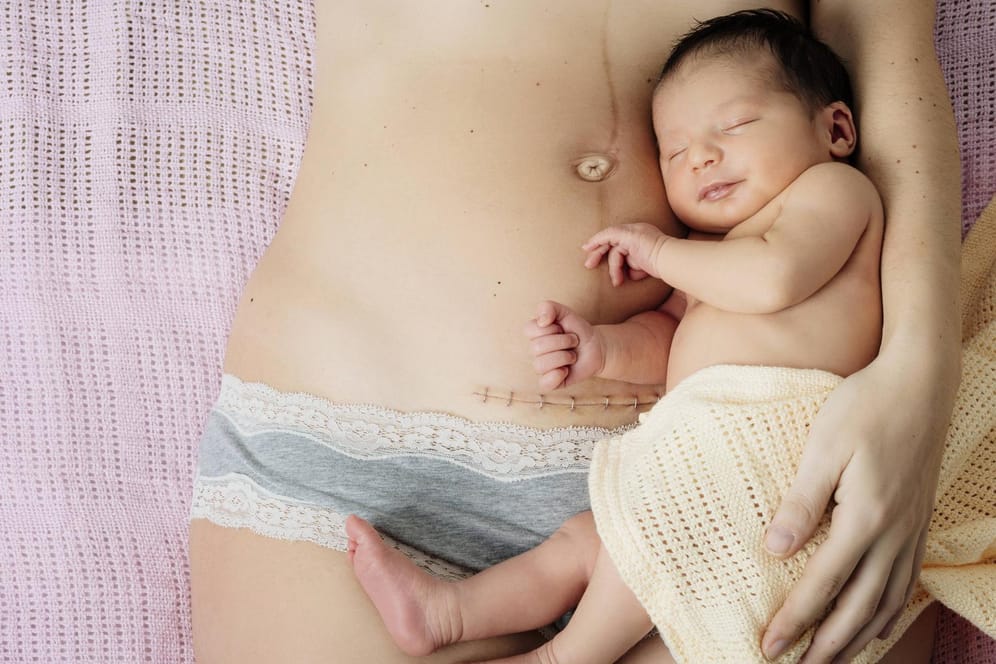 Kaiserschnitt: Ein Neugeborenes, welches neben seiner Mutter liegt. Zu sehen ist eine Narbe, die durch den Eingriff entstanden ist.