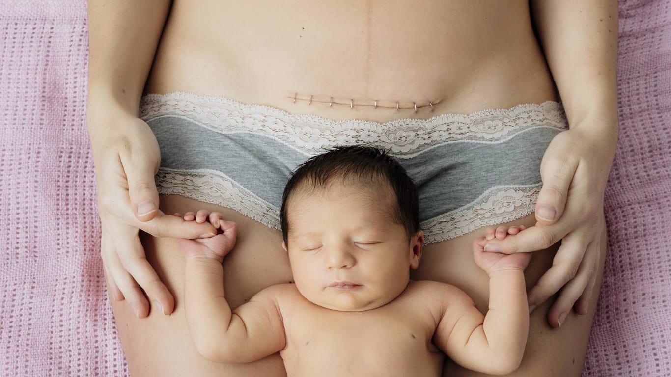 Nach dem Kaiserschnitt: Ein Säugling liegt auf dem Bauch der Mutter.