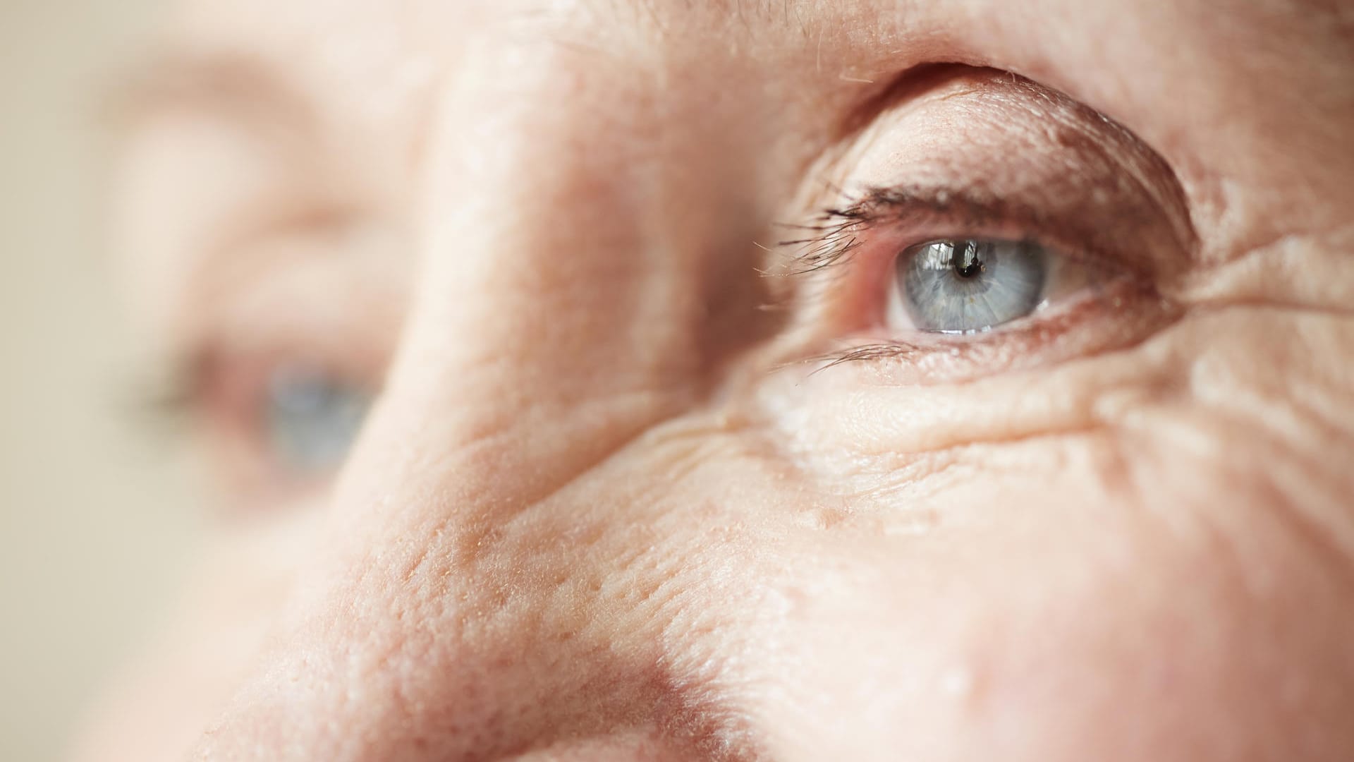 Weißliche Ringe auf der Hornhaut können auf einen erhöhten Cholesterinspiegel hinweisen und sollten vom Arzt abgeklärt werden.