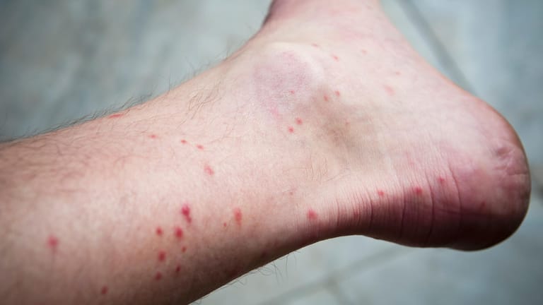 Rote Quaddeln am Fuß: Grasmilbenlarven beißen gerne in dünnhäutige Körperstellen wie Knöchel.