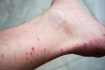 Rote Quaddeln am Fuß: Grasmilbenlarven beißen gerne in dünnhäutige Körperstellen wie Knöchel.