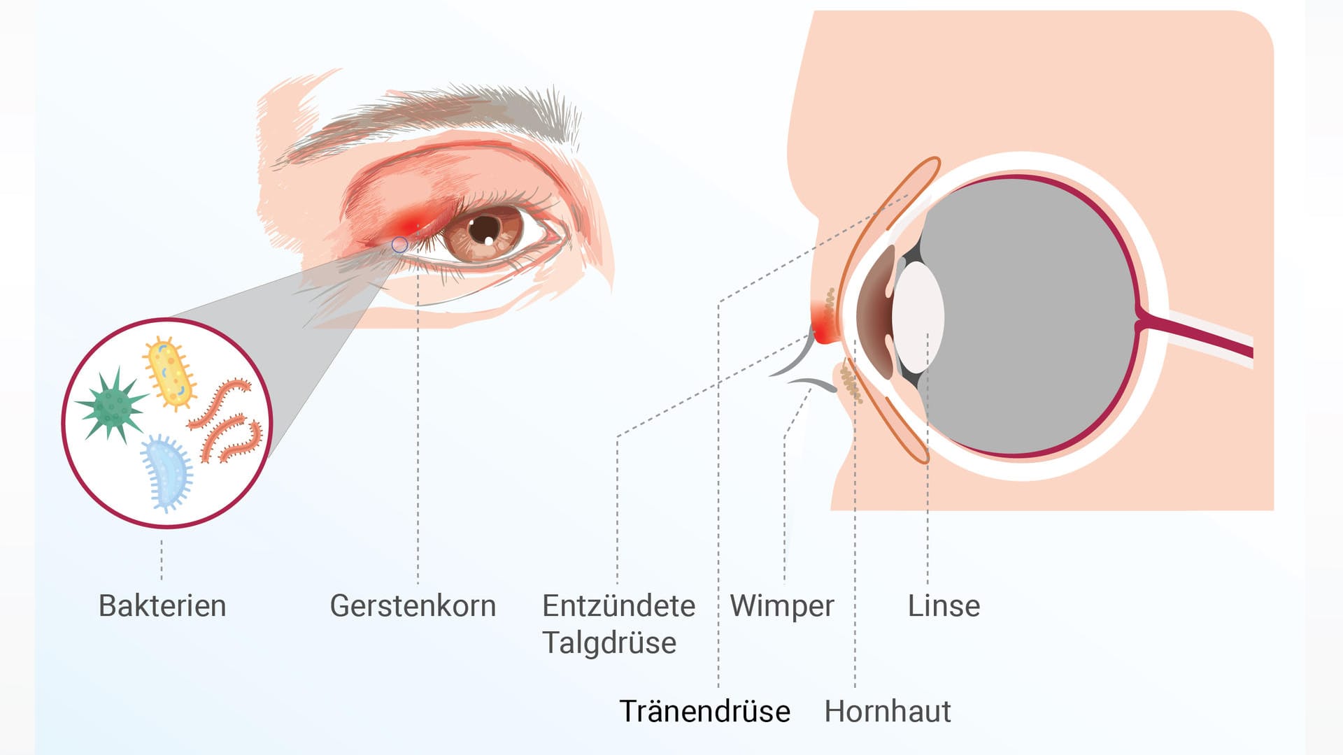 Grafische Darstellung eines Gerstenkorns: Bakterien siedeln sich in einer verstopften Drüse an.