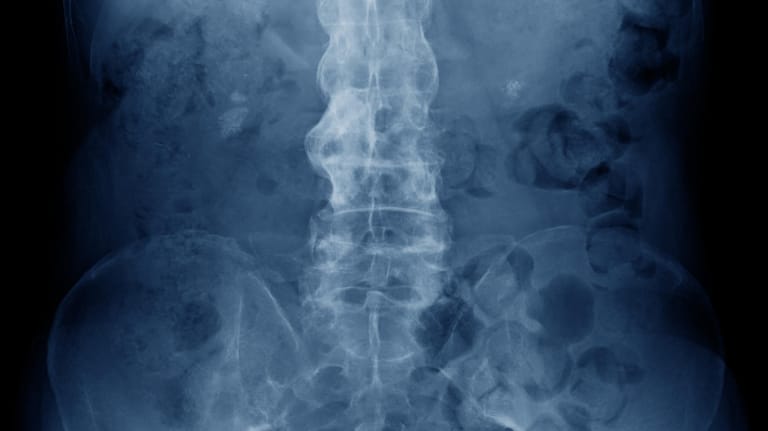Röntgenbild von der Wirbelsäule eines Mannes mit Morbus Bechterew. Die Verknöcherungen der Wirbel sind hier deutlich zu erkennen.