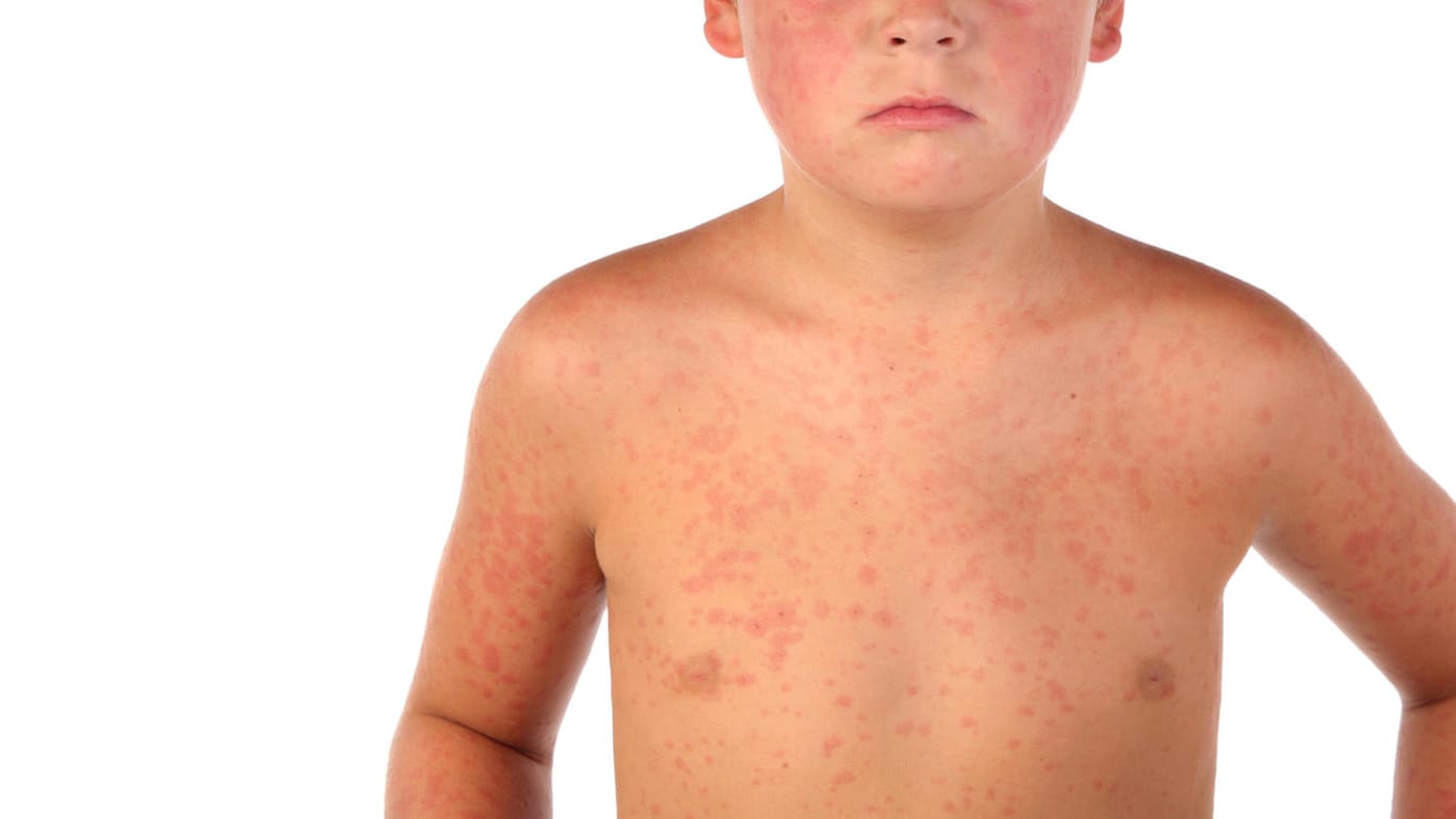 Junge mit roten Flecken auf der Haut: Prüfen Sie bei den ersten Anzeichen am besten sofort, ob es sich um eine Meningokokken-Meningitis handelt. (Symbolbild)