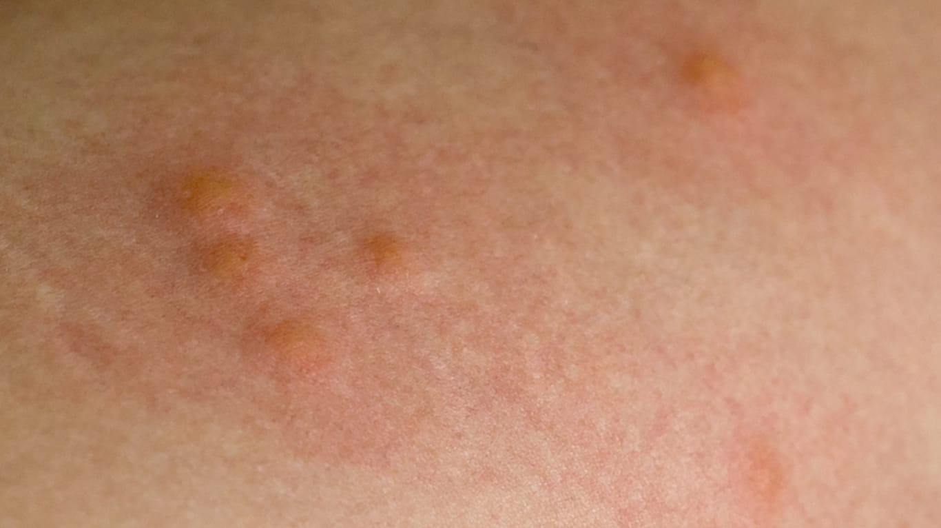 Mückenstiche: Kratzen verstärkt den Juckreiz und Entzündungen drohen.