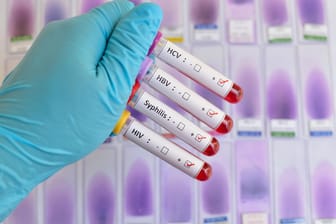 Bluttests: Das RKI sammelt Zahlen unter anderem zu Syphilis-Infektionen.
