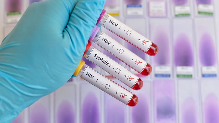 Bluttests: Das RKI sammelt Zahlen unter anderem zu Syphilis-Infektionen.