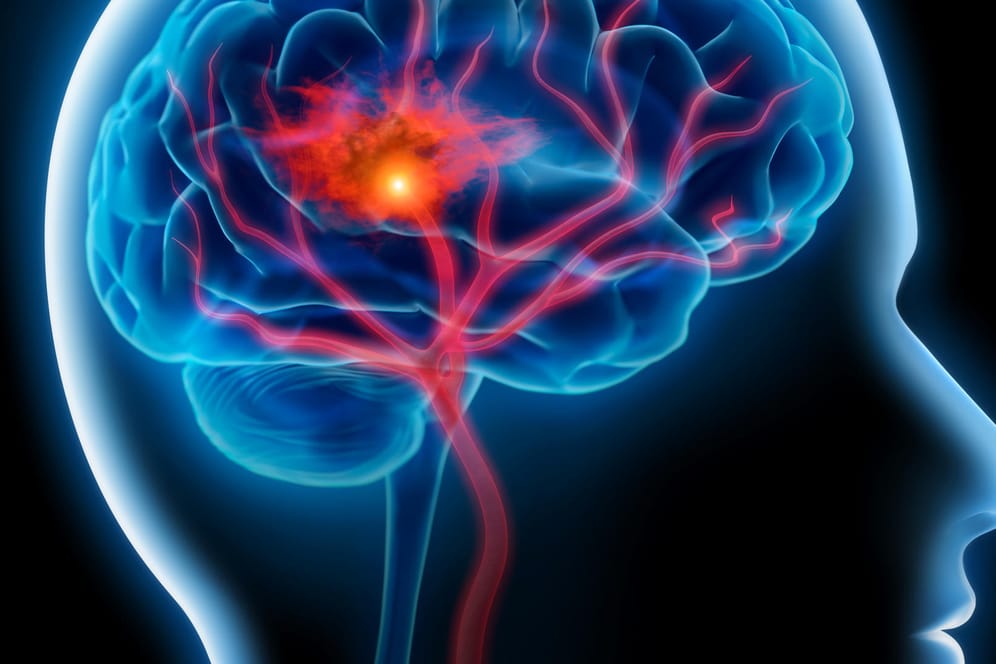 Grafische Darstellung des Gehirns nach einem Schlaganfall: Verstopfte Gefäße oder Blutgerinnsel können einen Hirnschlag auslösen.