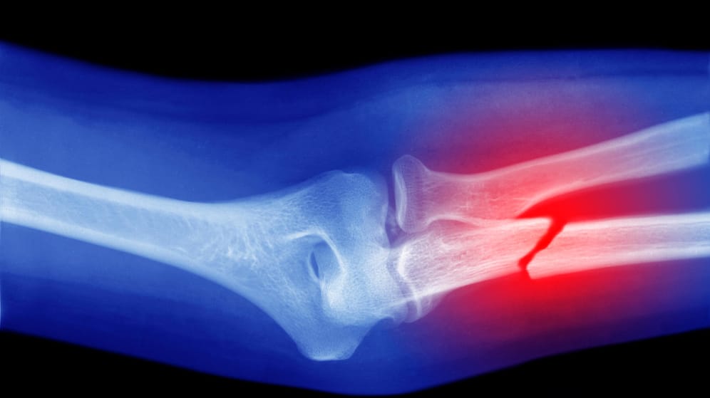 Fraktur des Unterarms in einer Röntgenaufnahme: Osteoporose führt dazu, dass die Knochen brüchig werden und oft schon bei geringem Anlass brechen.