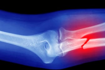 Fraktur des Unterarms in einer Röntgenaufnahme: Osteoporose führt dazu, dass die Knochen brüchig werden und oft schon bei geringem Anlass brechen.