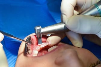 Molaren-Inzisiven-Hypomineralisation: In schweren Fällen bricht der Zahnschmelz ein.