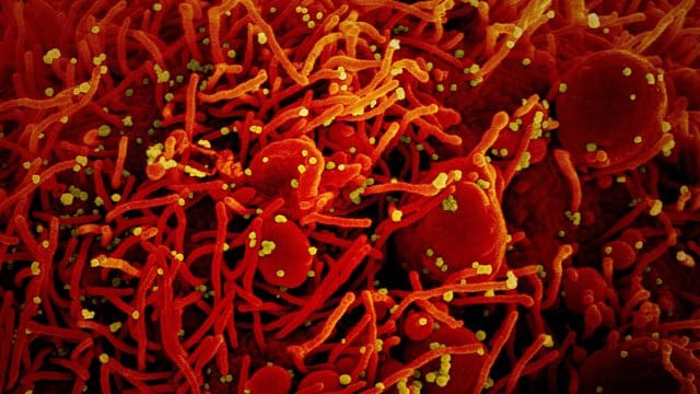 Auf dieser vom US-Forschungszentrum "National Institute of Allergy and Infectious Diseases" (NIAID) zur Verfügung gestellten Aufnahme ist eine Zelle (rot) mit dem Coronavirus (SARS-CoV-2, gelb) infiziert. Auf dieser vom US-Forschungszentrum "National Institute of Allergy and Infectious Diseases" (NIAID) zur Verfügung gestellten Aufnahme ist eine Zelle (rot) mit dem Coronavirus (SARS-CoV-2, gelb) infiziert.