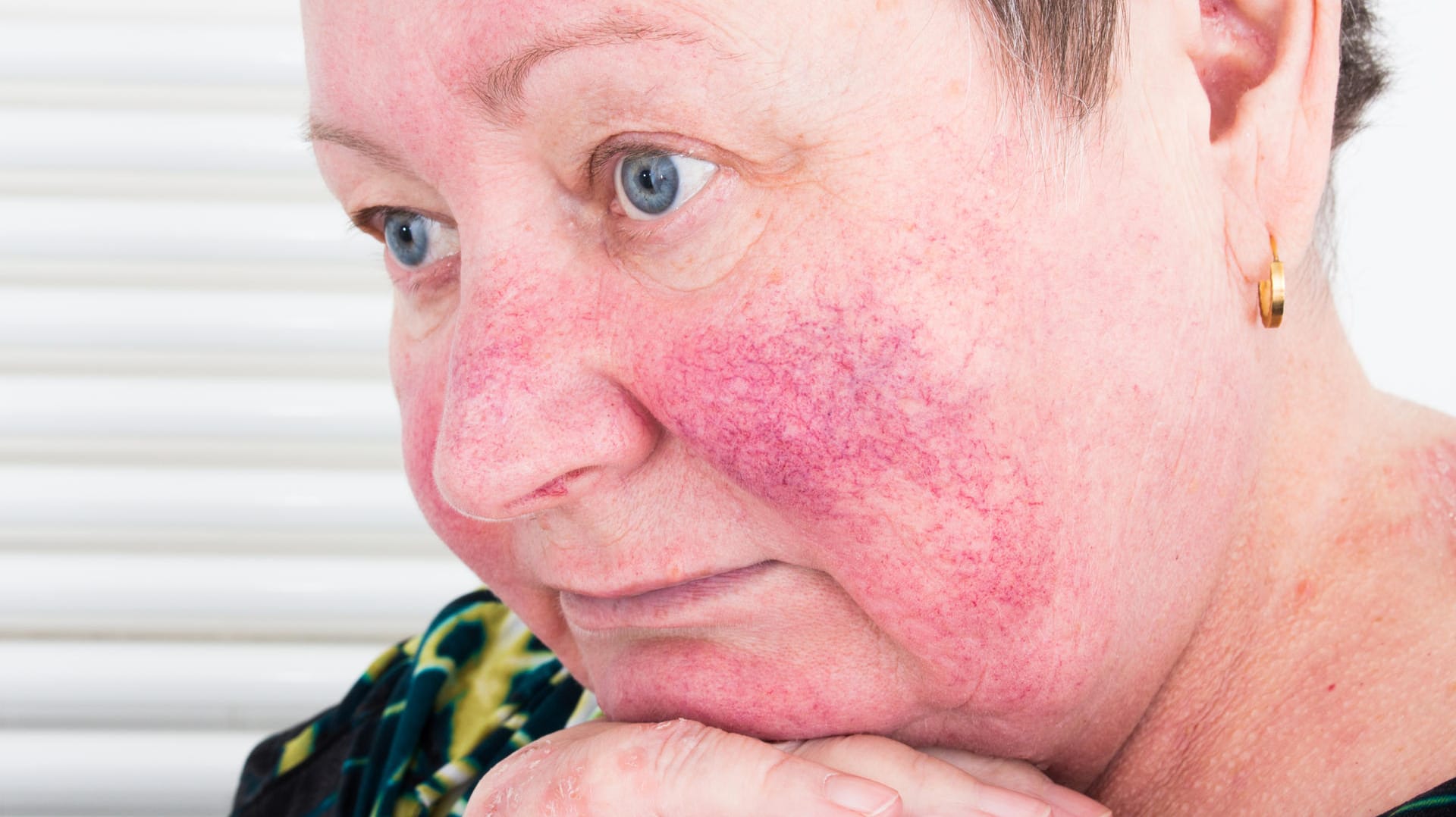 Rosacea: Die Erkrankung wird in drei Stadien eingeteilt, die aber nicht unbedingt ineinander übergehen.