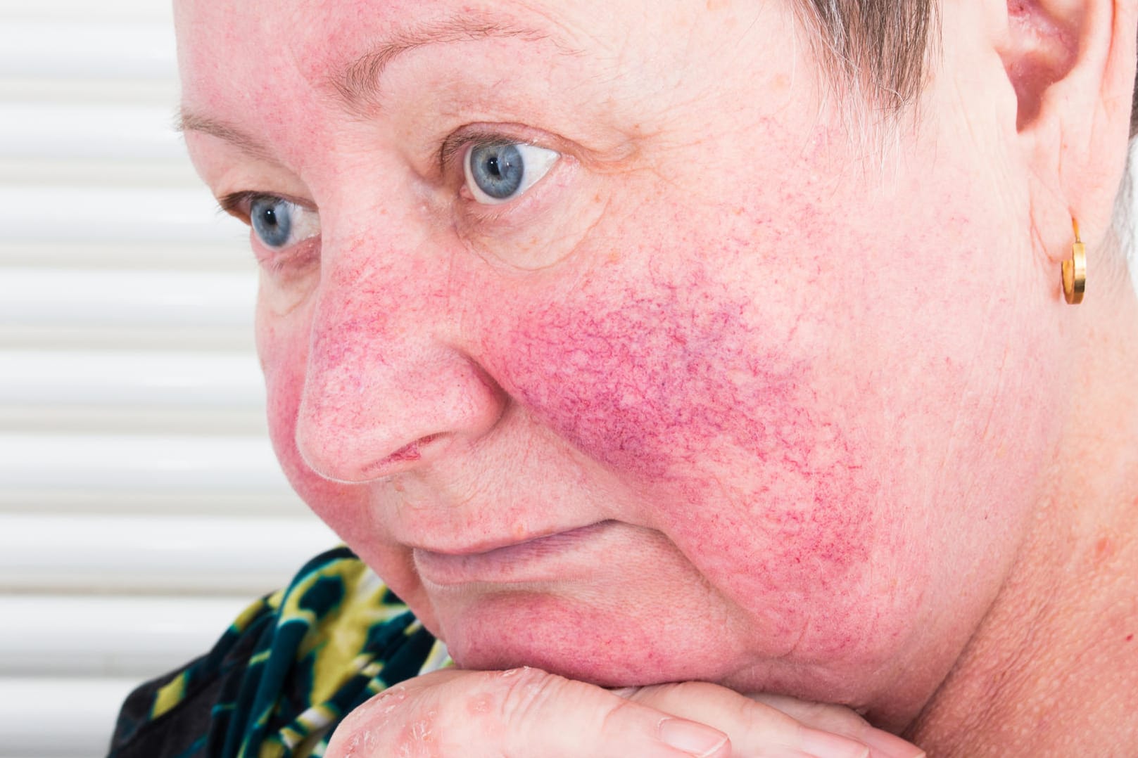 Rosacea: Die Erkrankung wird in drei Stadien eingeteilt, die aber nicht unbedingt ineinander übergehen.