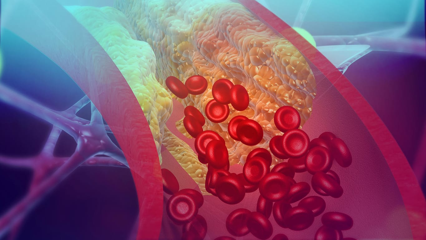 Cholesterin: Befindet sich allerdings über Jahre hinweg zu viel LDL-Cholesterin im Blut, setzt es sich an den Gefäßwänden ab.