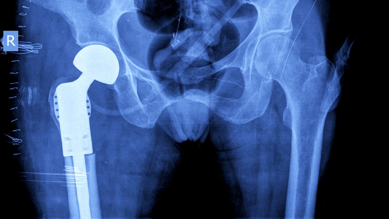 Hüftprothese: Ein künstliches Hüftgelenk kann die Beschwerden bei über 90 Prozent der Menschen deutlich bessern.