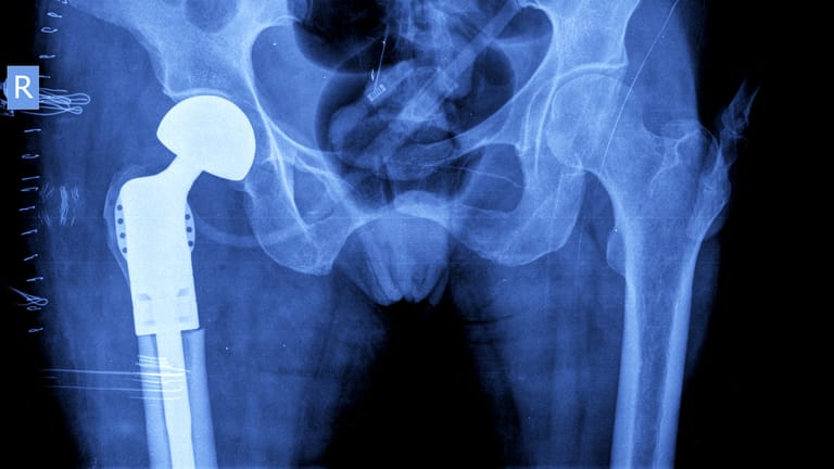 Hüftprothese: Ein künstliches Hüftgelenk kann die Beschwerden bei über 90 Prozent der Menschen deutlich bessern.