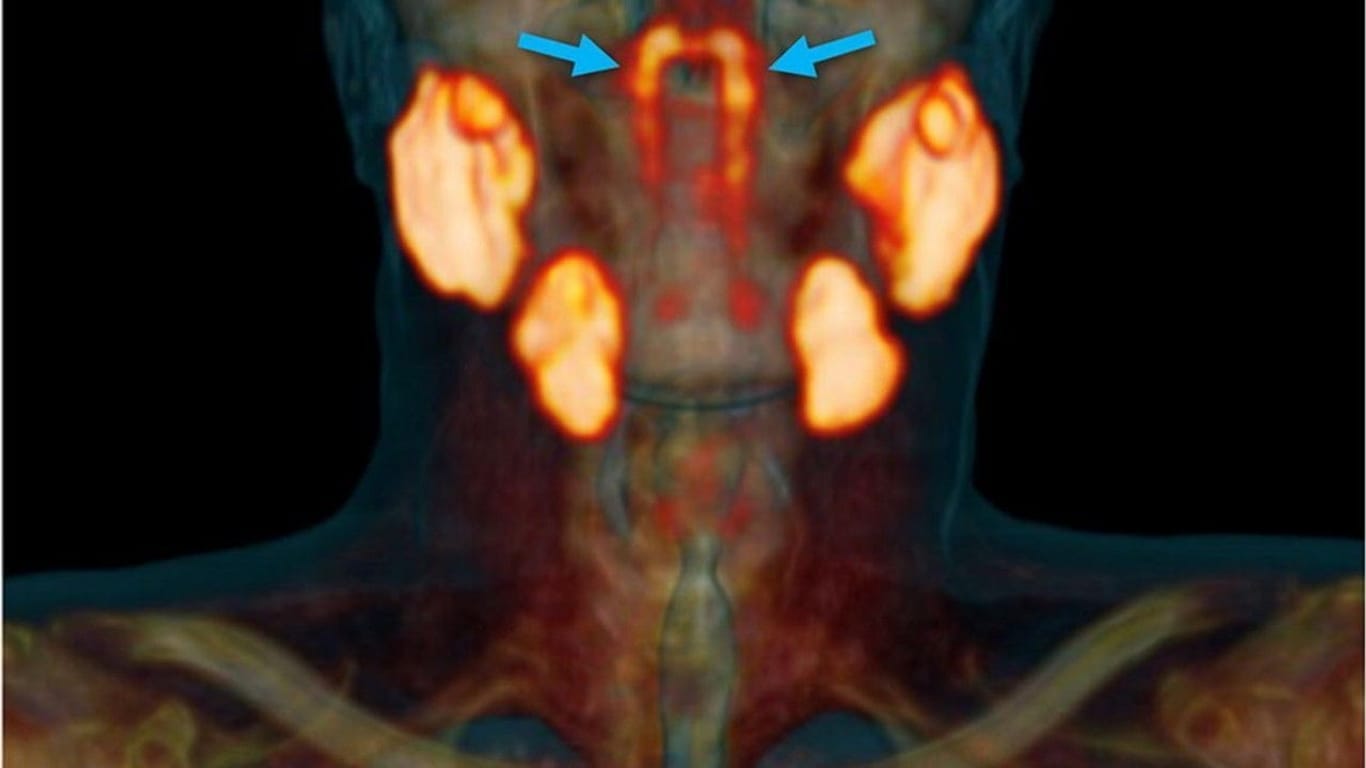 Scan eines Kopfes: Die neu entdeckte Speicheldrüse befindet sich im Rachenraum.