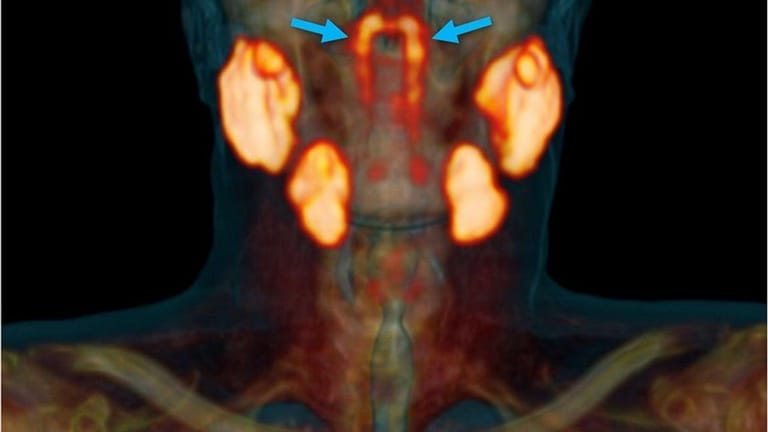 Scan eines Kopfes: Die neu entdeckte Speicheldrüse befindet sich im Rachenraum.