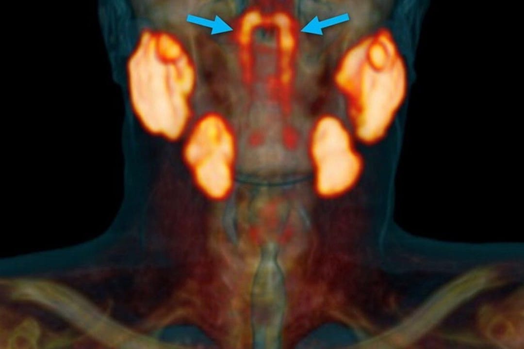 Scan eines Kopfes: Die neu entdeckte Speicheldrüse befindet sich im Rachenraum.