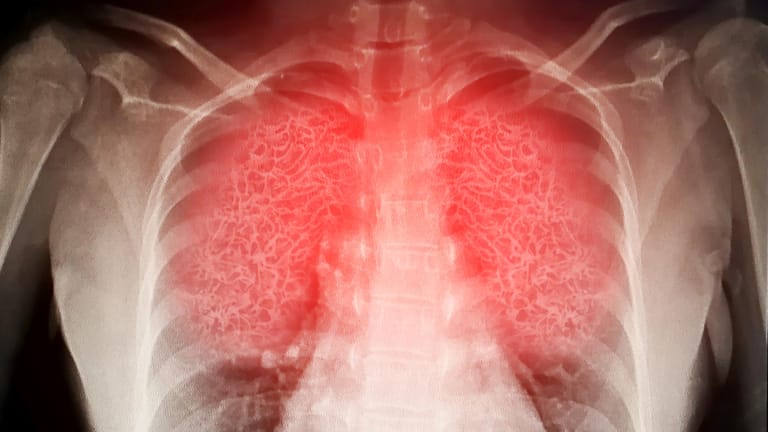 Lunge: Das Coronavirus SARS-CoV-2 kann sämtliche Organe befallen. (Symbolbild)