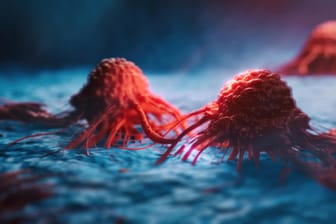 3D-Illustration von Krebszellen: Die häufigste Krebsart weltweit ist Lungenkrebs.