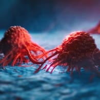 3D-Illustration von Krebszellen: Die häufigste Krebsart weltweit ist Lungenkrebs.