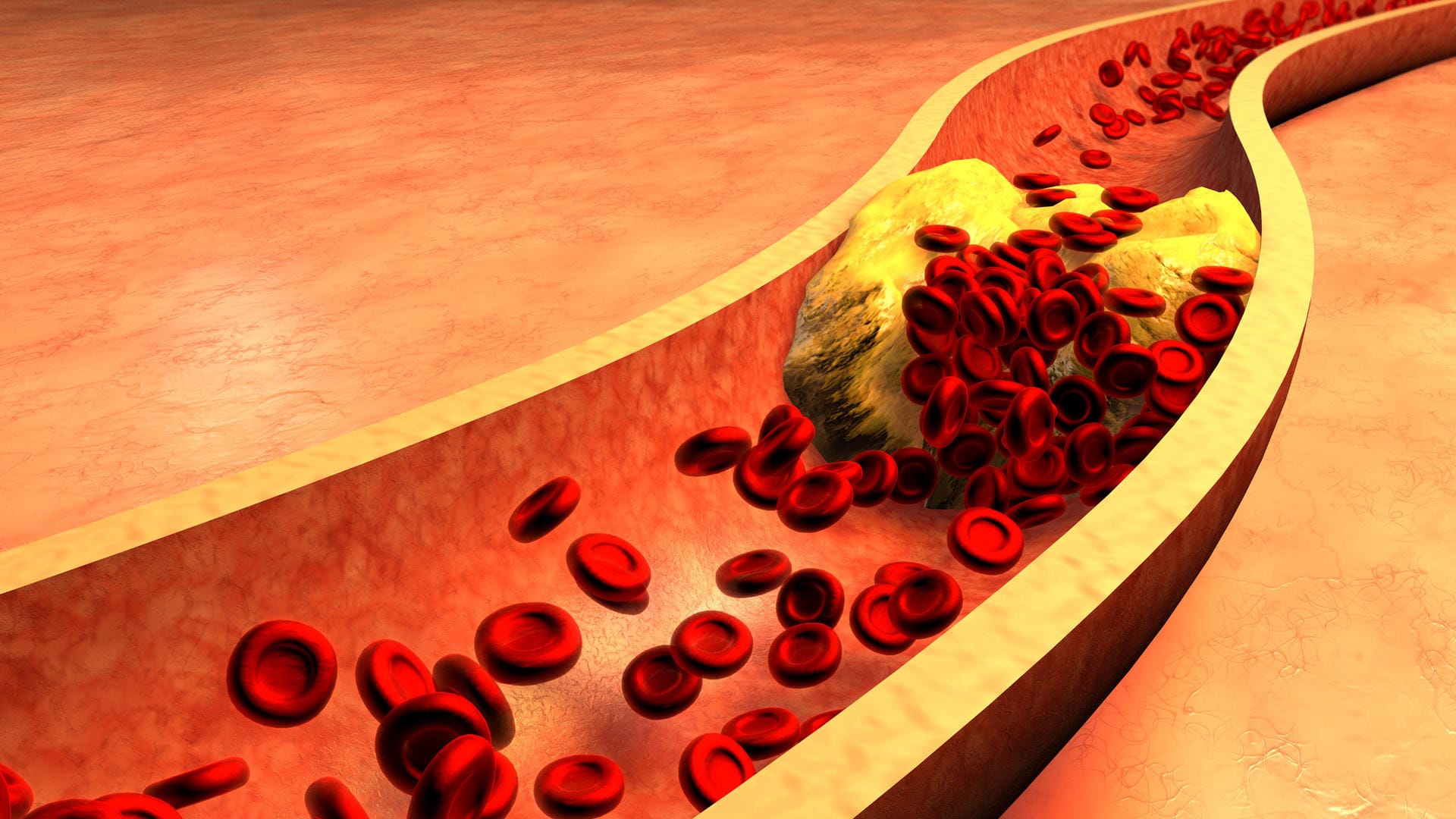 Die Grafik zeigt eine verstopfte Arterie mit Cholesterinablagerungen. Dadurch wird die Durchblutung beeinträchtigt und es kommt zu einer peripheren arteriellen Verschlusskrankheit.