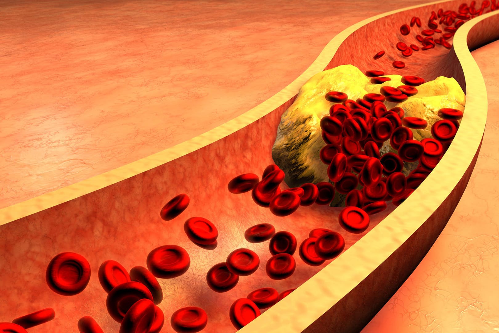 Die Grafik zeigt eine verstopfte Arterie mit Cholesterinablagerungen. Dadurch wird die Durchblutung beeinträchtigt und es kommt zu einer peripheren arteriellen Verschlusskrankheit.