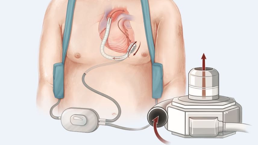 Grafik eines Kunstherzsystems: Über ein Rohr fließt das Blut aus der Herzkammer in eine kleine Pumpe. Diese pumpt das Blut in die Hauptschlagader. Für die Stromversorgung führt ein Kabel aus dem Körper heraus und wird an eine Steuereinheit angeschlossen.