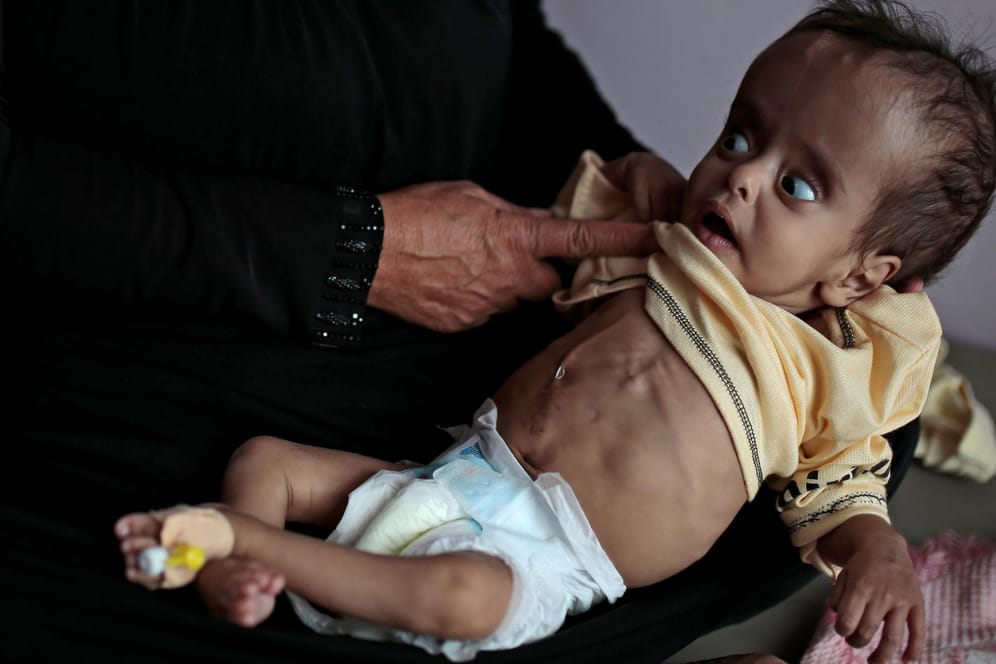 Drohende Hungersnot: Eine Frau hält ihren unterernährten Jungen im Al Sabeen Krankenhaus im Arm.