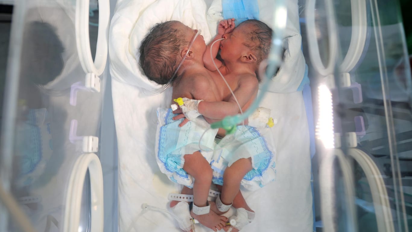 Siamesische Zwillingsjungs im Jemen: Nur eine Operation im Ausland kann ihr Leben retten.