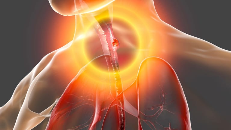 3-D-Aufnahme der Speiseröhre mit einem Tumor: Speiseröhrenkrebs gehör zu den seltenen Krebsarten.