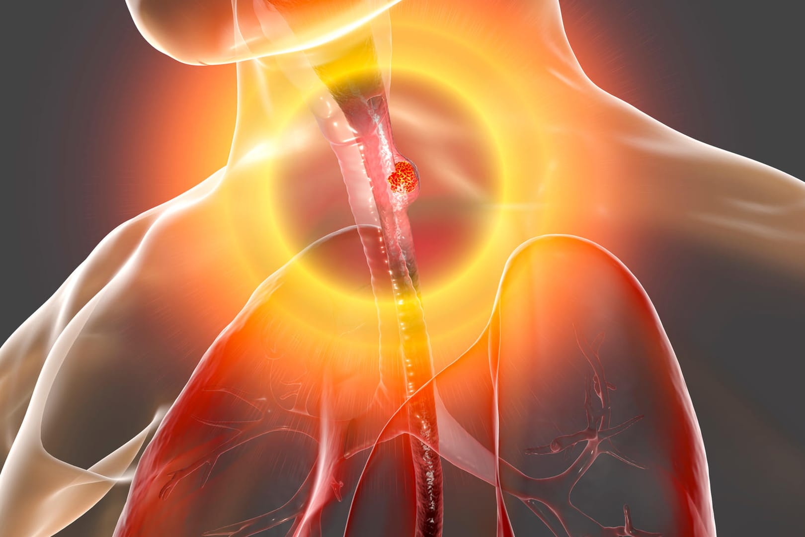 3-D-Aufnahme der Speiseröhre mit einem Tumor: Speiseröhrenkrebs gehör zu den seltenen Krebsarten.