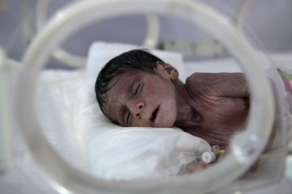 Ein unterernährtes Neugeborenes liegt in einem Inkubator im internationalen Krankenhaus UniMax in Sanaa.