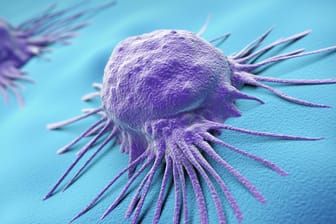 Krebszellen: Sie dringen immer tiefer in angrenzendes Gewebe vor, wo sie sich vermehren und das gesunde Gewebe mehr und mehr zerstören.