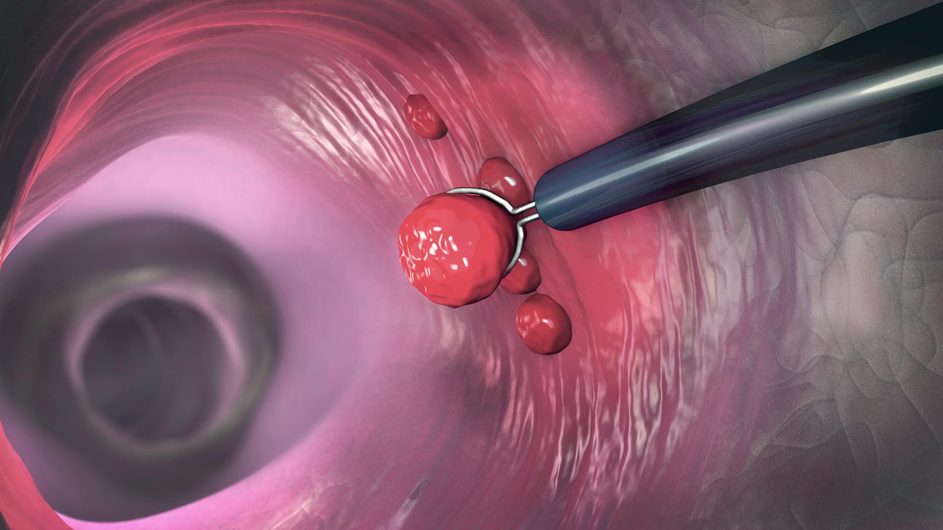 3-D-Illustration des menschlichen Darms: Bei einer Koloskopie können Polypen in der Darmwand mithilfe einer Zange schonend entfernt werden.