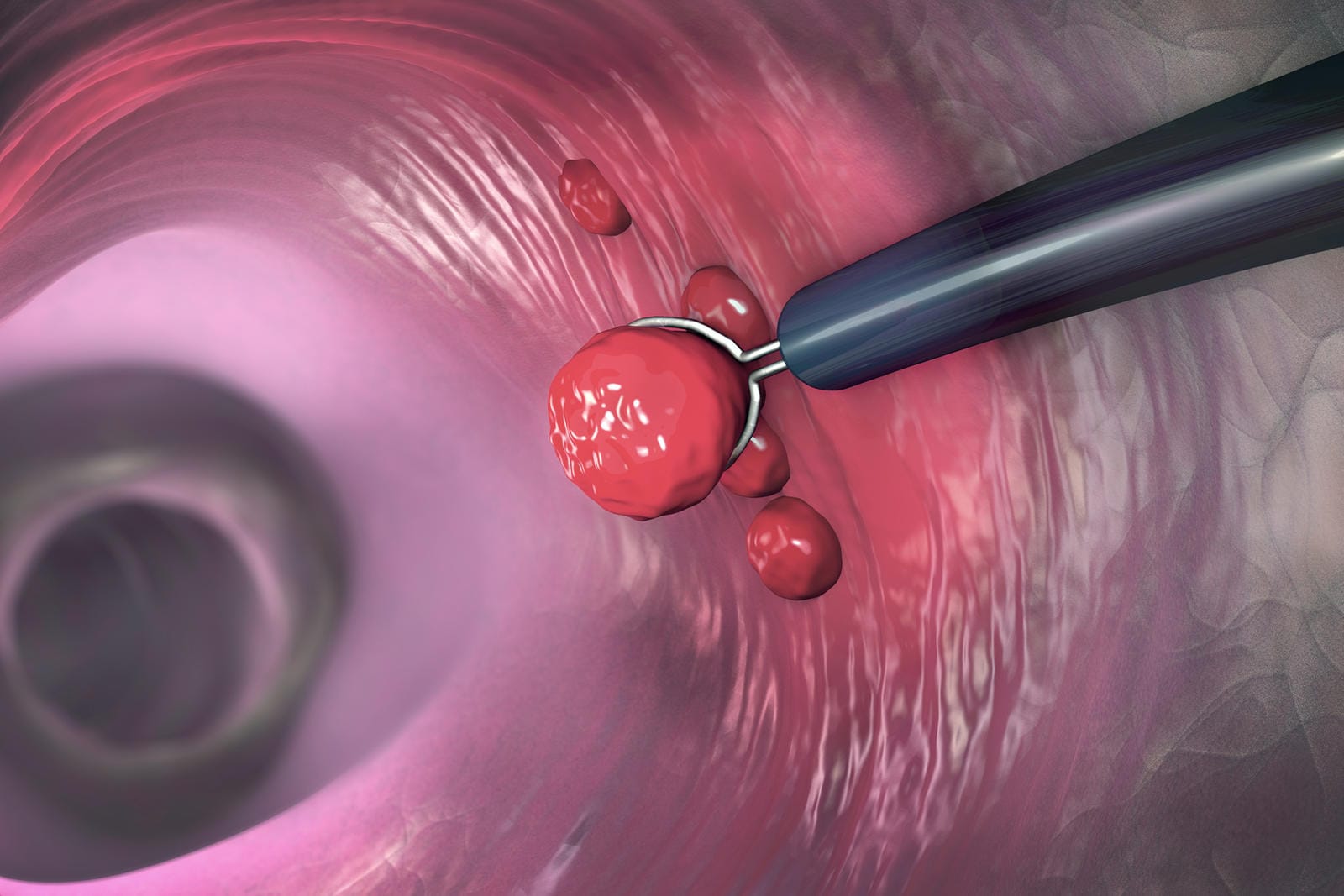 3-D-Illustration des menschlichen Darms: Bei einer Koloskopie können Polypen in der Darmwand mithilfe einer Zange schonend entfernt werden.