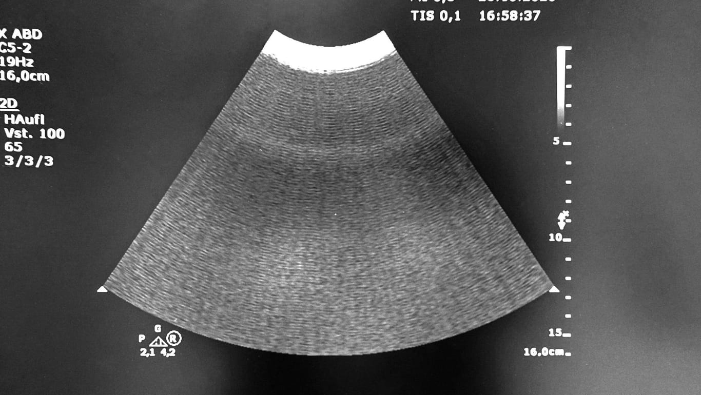 Ein Ultraschallbild (Symbolbild): Am UKSH wird eine Ultraschallmethode zur Behandlung von Tremorpatienten angewendet.